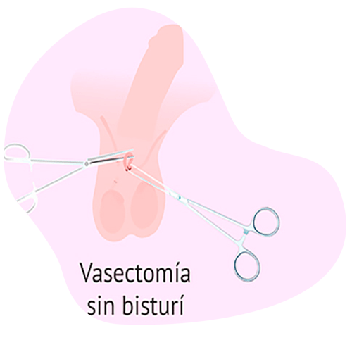 vasectomia sin bisturi Vasectomía sin bisturí